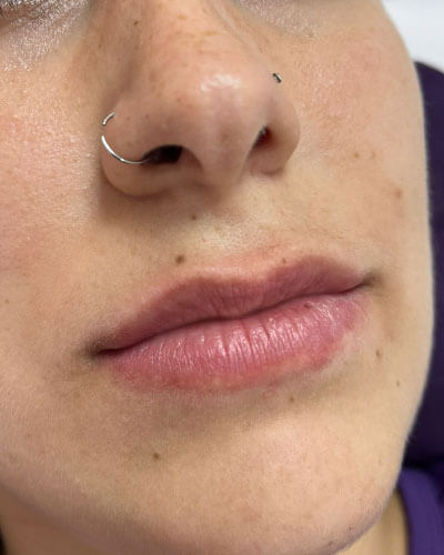 Preenchimento Labial