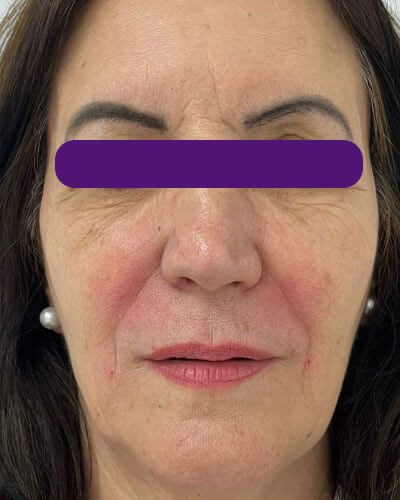 Rejuvenescimento Facial